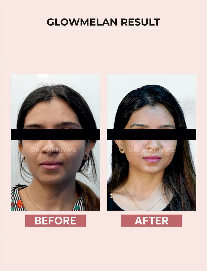 GLOWMELAN Result