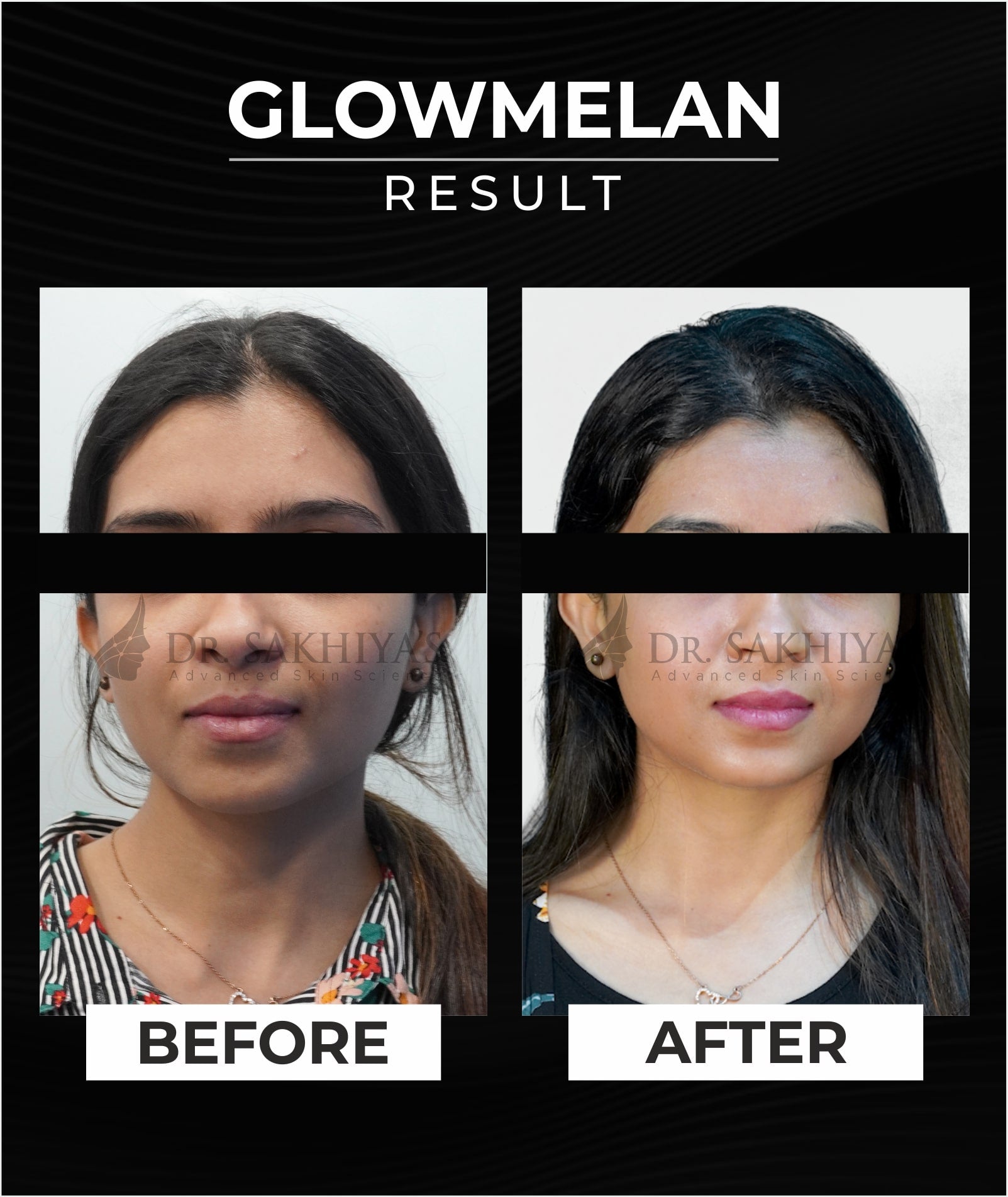 Before And After Result of Dr. Sakhiya's Glowmelan Skin Brightening Cream