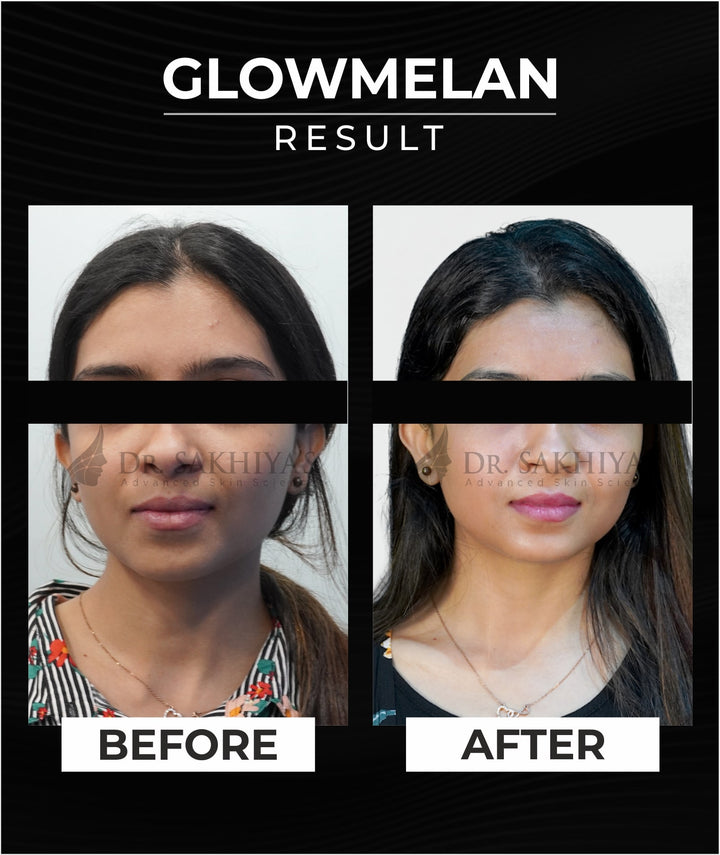 Before And After Result of Dr. Sakhiya's Glowmelan Skin Brightening Cream