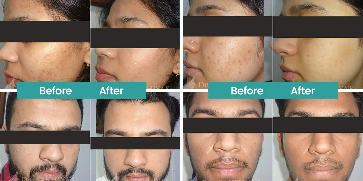 Advanced Acne & Pimple Care Kit | Dermatologically Recommended